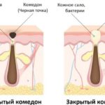 Як позбутися чорних крапок на обличчі: ефективні методи боротьби з комедонами