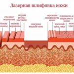 Лазерна шліфовка: особливості процедури і показання до проведення