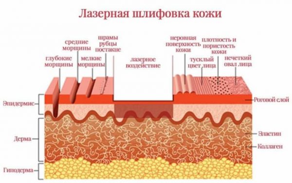 Лазерна шліфовка: особливості процедури і показання до проведення