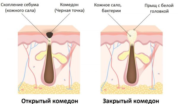 Масло від чорних крапок: як зробити правильний вибір