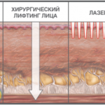 Особливості ультразвукової підтяжки обличчя в косметологічної клініці і вдома