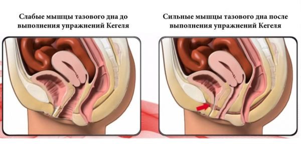 Вправи Кегеля при опущенні матки: як позбутися від делікатної проблеми