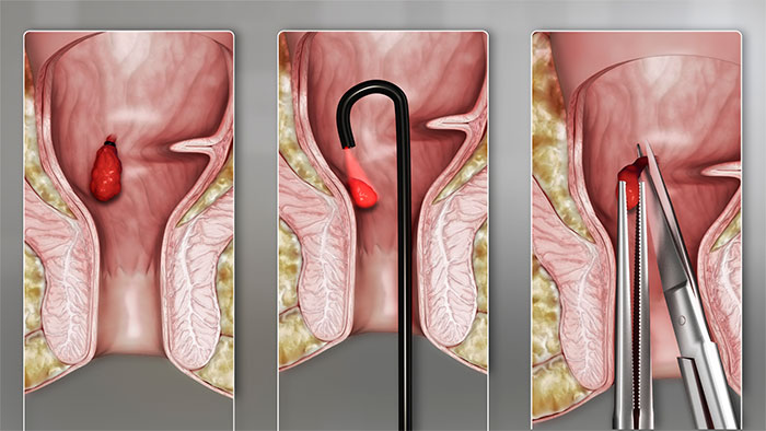 методы лечения геморроя
