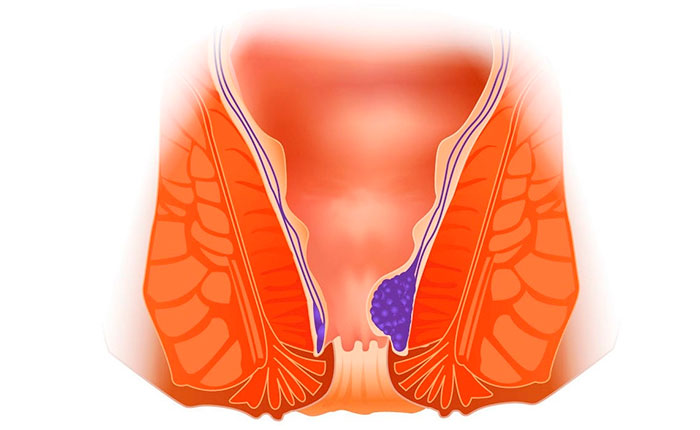 методы лечения геморроя